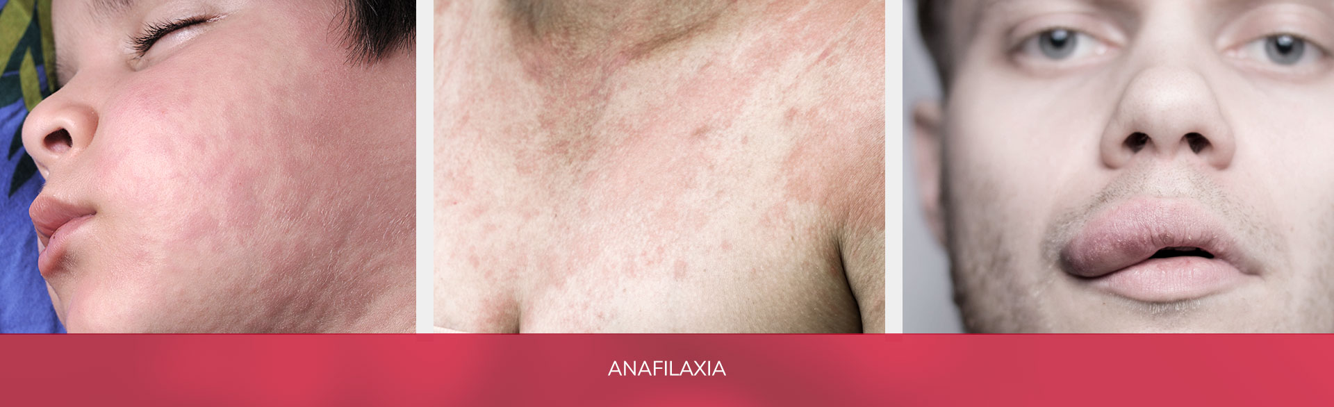 La anafilaxia es el tipo más severo y grave de alergia. Constituye una emergencia médica y es potencialmente mortal a corto plazo.